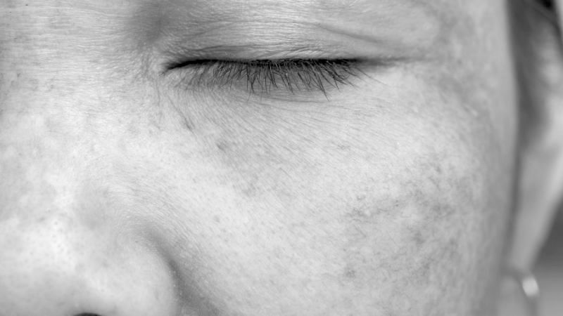 Sun Damaged skin treatment - book an appointment today Plymouth