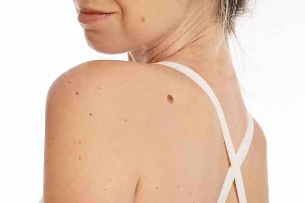 Why Professional Skin Tags Removal Is Better Than DIY Methods in Plymouth