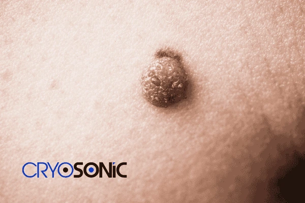 Looking for non surgical Dermatofibroma removal Plymouth? Contact us today Plymouth