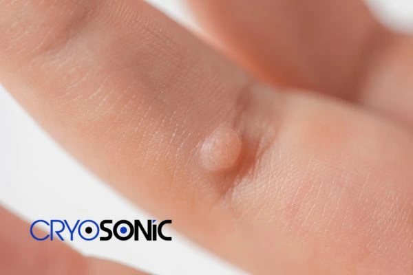 Contact Cryosonic today to learn more about us Plymouth now! Plymouth