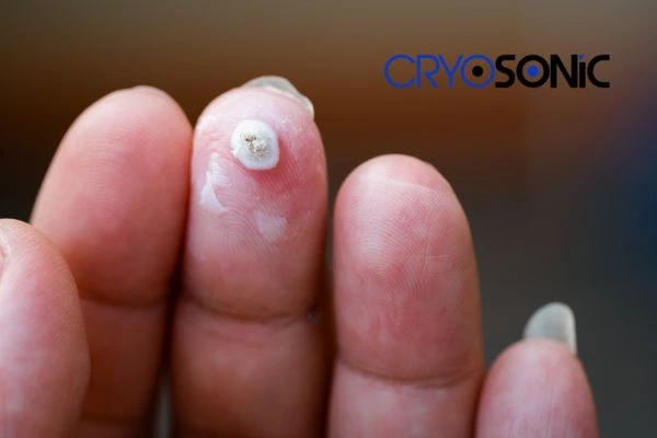 Learn more about us Plymouth at Cryosonic. Book in today! Plymouth