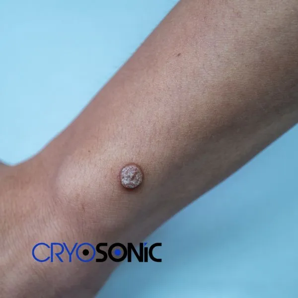 Deep Verrucae removal treatment possible from your own home! Book treatment today Plymouth