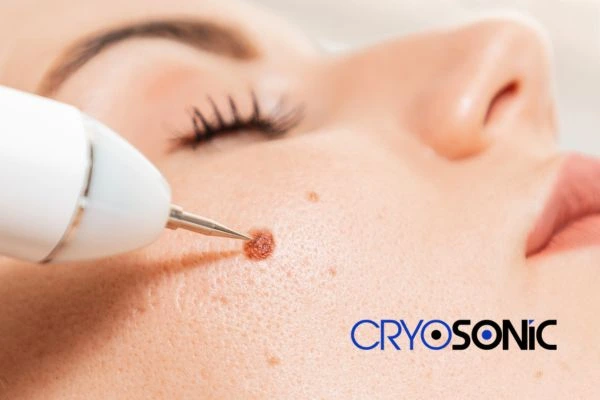 why choose us at Cryosonic for blemish removal? Find out more now Plymouth