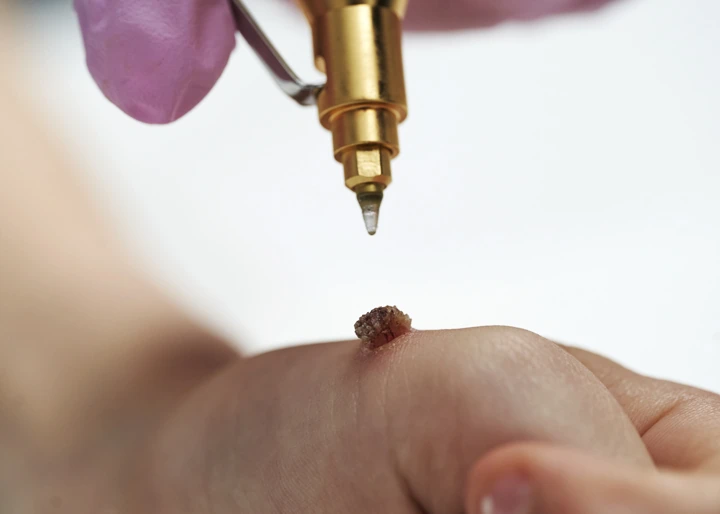 Cryopen For Children Bristol Plymouth