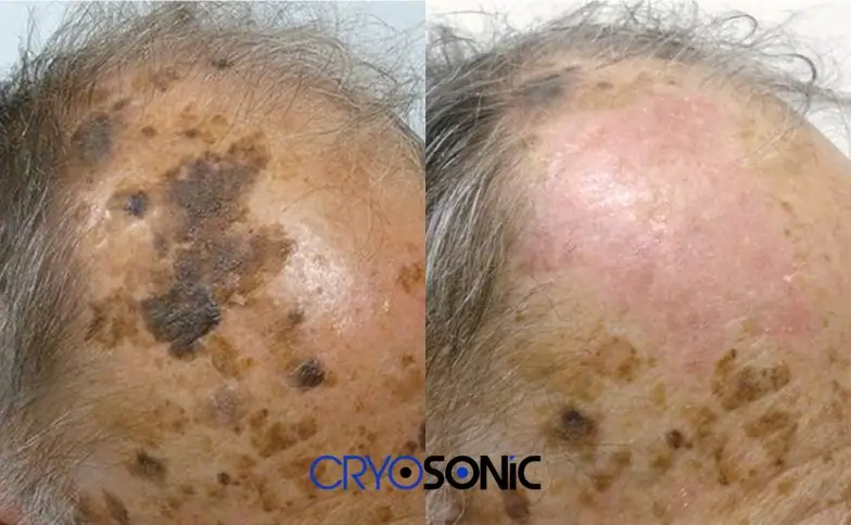 Seborrhoeic Keratosis Removal before and after Plymouth