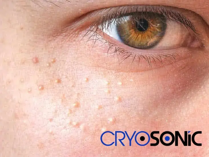 Cryosonic&rsquo;s CryoPen Approach to Milia Removal Plymouth Plymouth