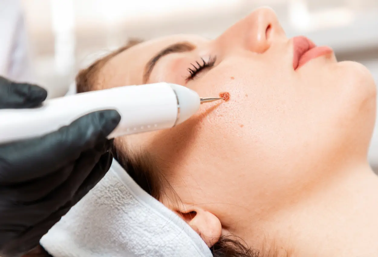 Frequently Asked Questions About Multiple Cryotherapy Treatments Plymouth