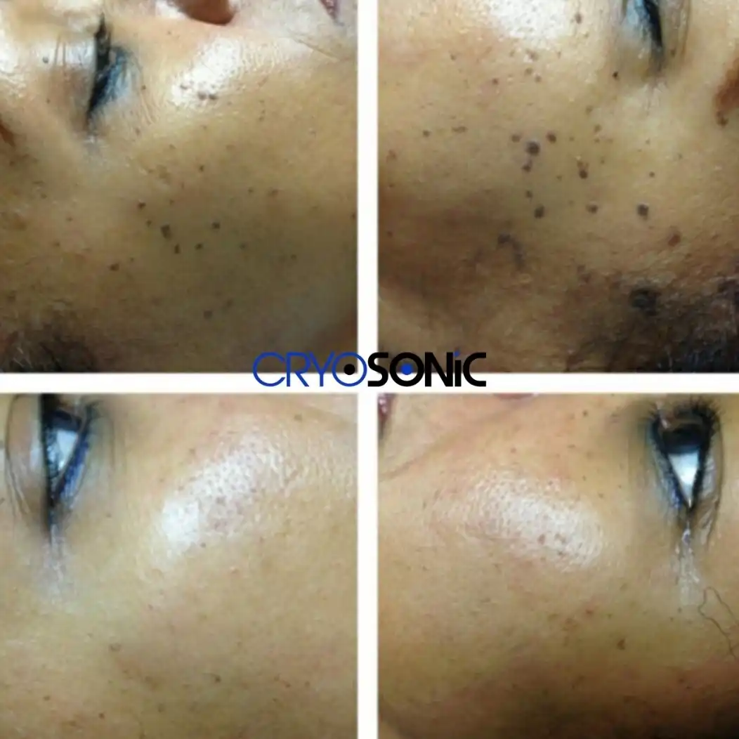 Why Skin Shows Pigmentation After Treatment Plymouth