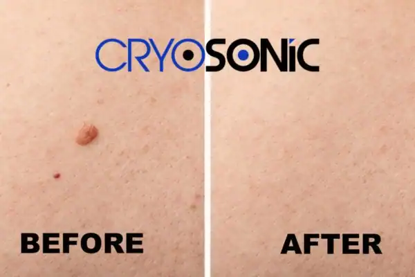Before and after results of Cryofreeze Lesion Removal Service Plymouth Plymouth