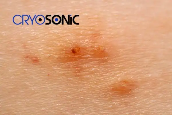 Image of Molluscum Contagiosum Treatment Plymouth Plymouth