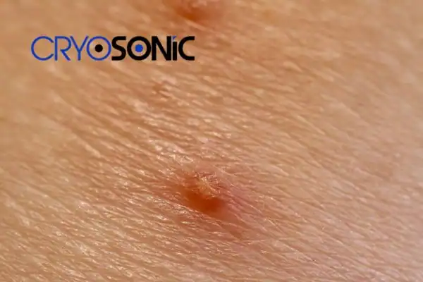 Molluscum Contagiosum Treatment Plymouth Plymouth