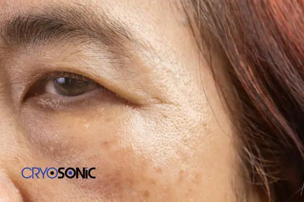 Image of age spot treatment Plymouth Plymouth
