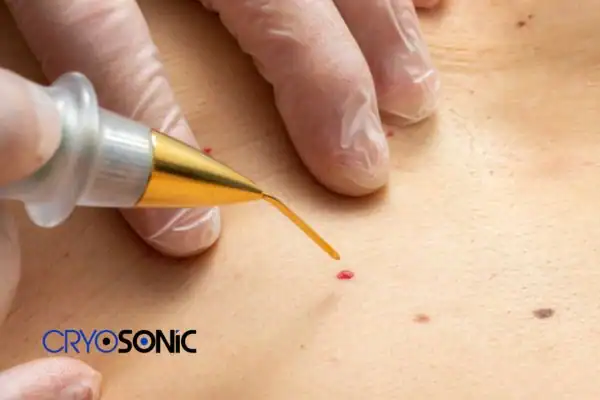 Image of cherry angioma removal Plymouth Plymouth