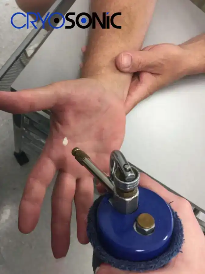 Temperature Differences: OTC vs Medical-Grade Cryotherapy Plymouth